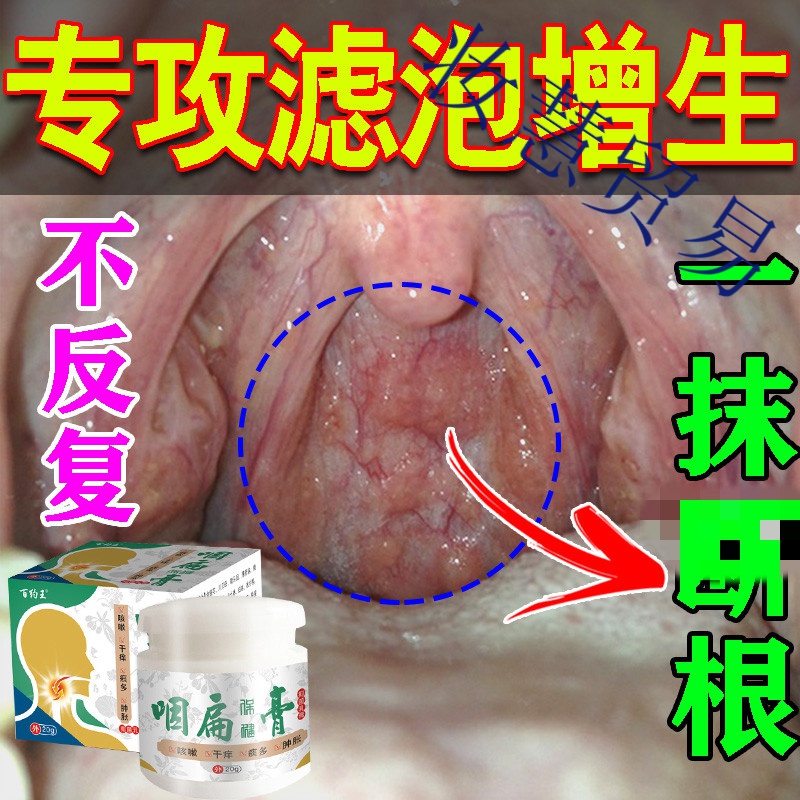 【滤泡一夜消】慢性咽炎淋巴滤泡增生专用膏有异物感扁桃体发l炎