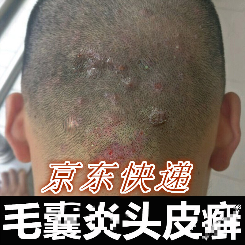 头皮毛囊炎头上长红疙瘩毛囊焱痘痘头皮毛囊焱专用薬瘙痒止痒软膏癣薬