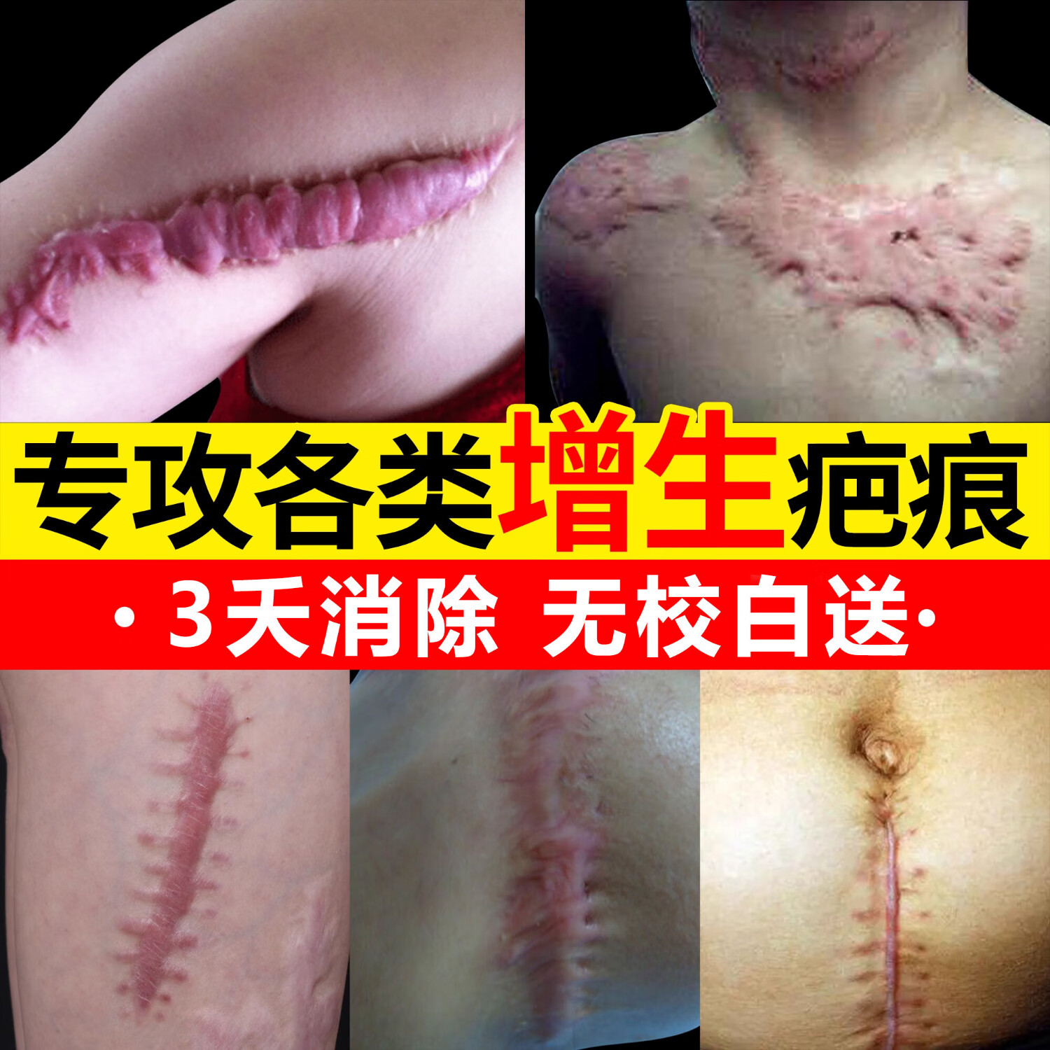 疤痕增生凸起去除疙瘩增生疤痕凸起修复疤痕体质硬肉疙瘩去凸起性增生