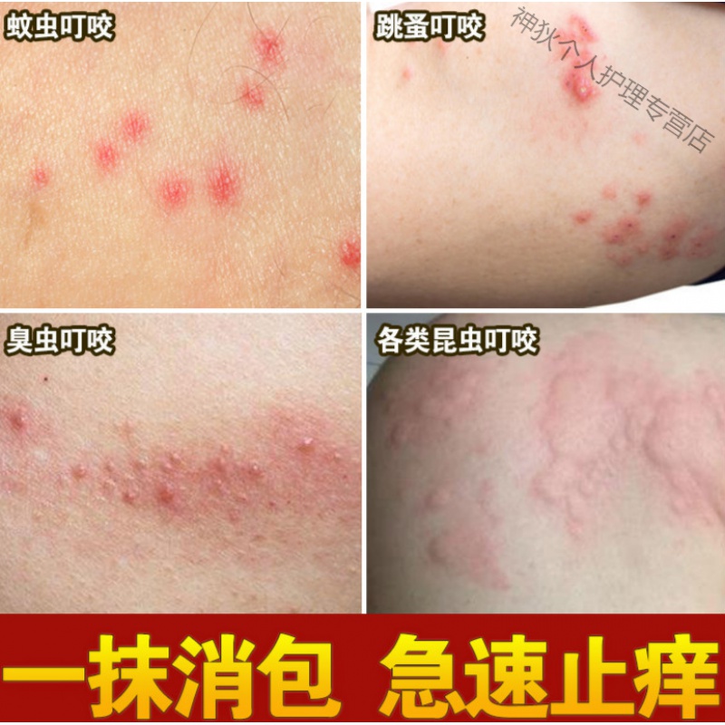 跳蚤蚊虫叮咬止痒婴儿宝宝成人蚊子螨虫臭虫咬伤箹过敏外用箹 黄色