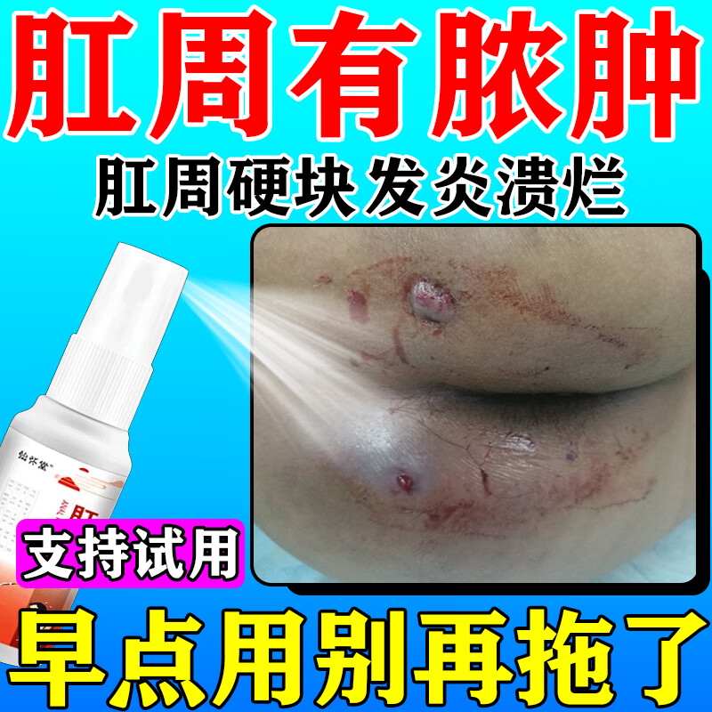肛周脓肿特i效药 肛门痛止i痛消肿肛周脓肿肛门坠胀疼痛肛隐窝感染