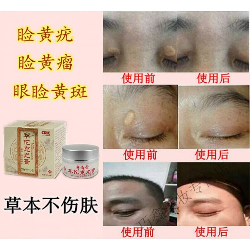 【官方】除睑黄疣圆眼部睑黄瘤膏除汗管瘤眼皮脸黄斑瘤 用草本康1 用