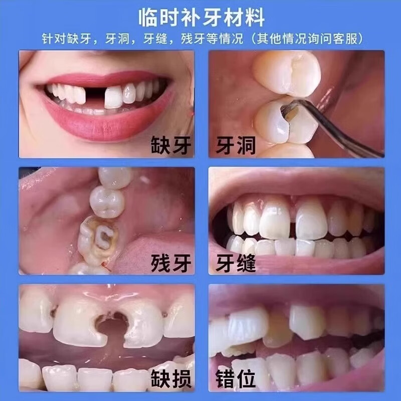 补牙材料永久自己在家补牙洞填充剂牙缝宽大修护树脂补牙材料医用 三包装【能补30颗牙】