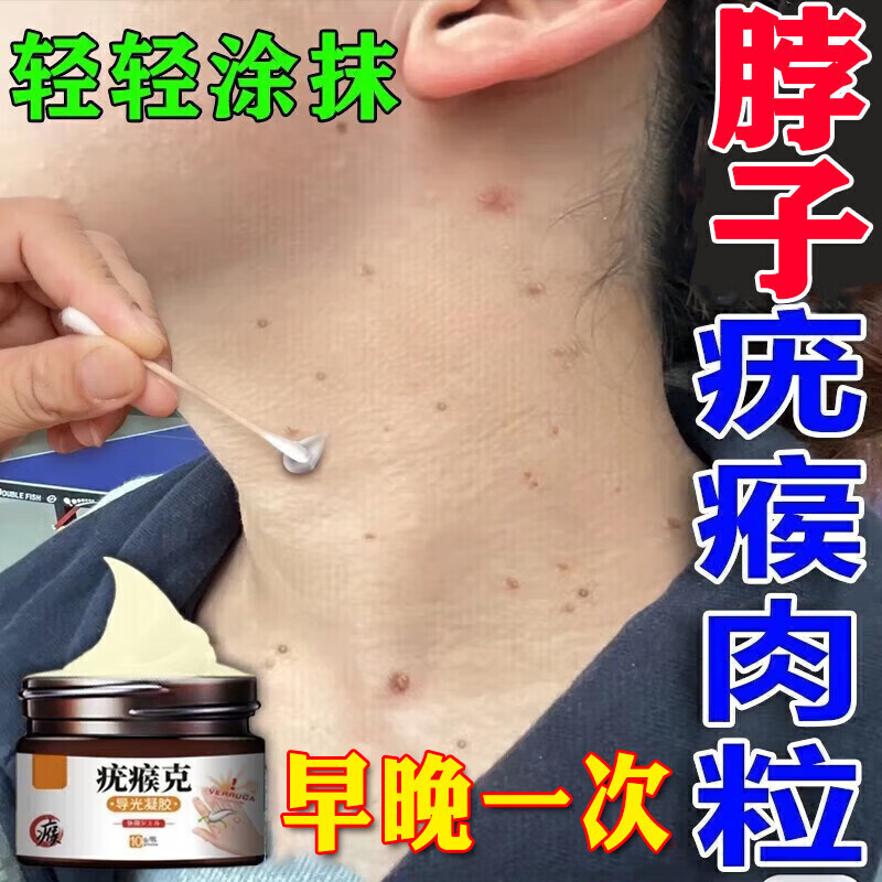 去疣灵扁平疣面部专用的药脖子瘊子去疣膏去疣体特傚效药神器快速去除