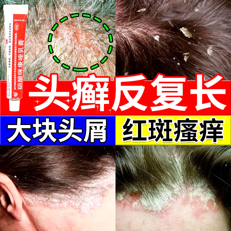 治头癣头皮癣专用药膏头皮痒脂溢性皮炎毛囊炎头部专用药银屑头皮屑