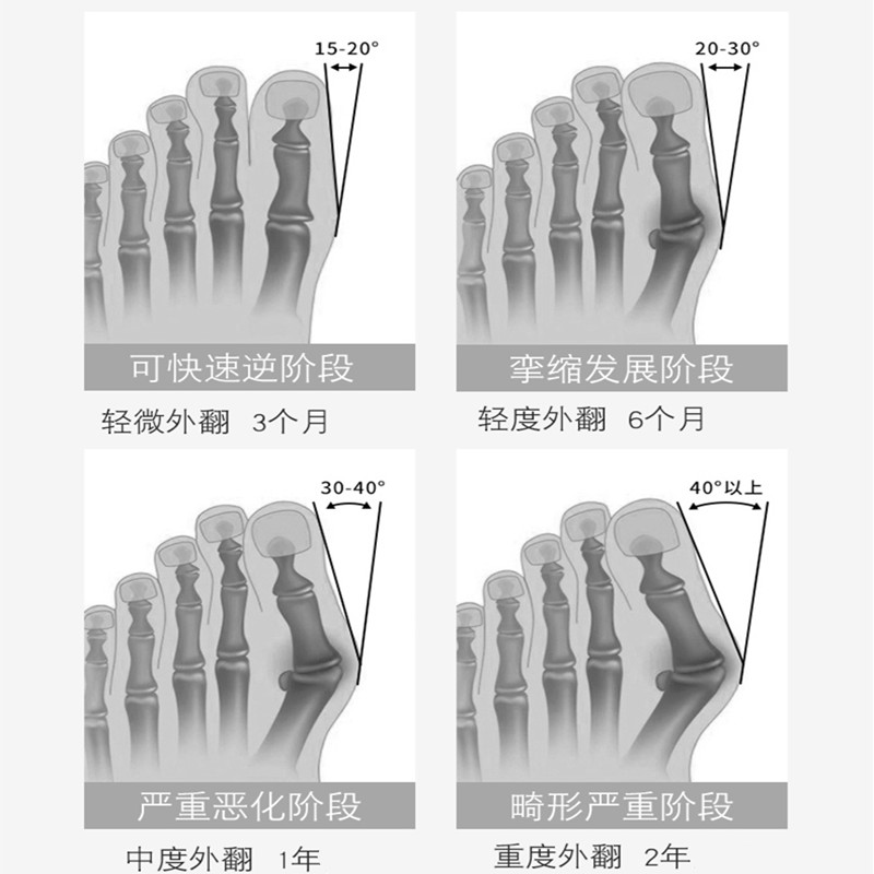 陌牛 日本原产拇指外翻矫正器医用大母指矫正袜大脚骨脚趾分离器可外穿鞋日夜装成人儿童男女士通用