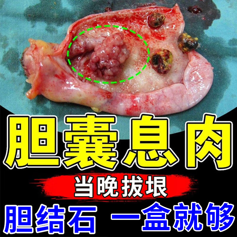 胆囊息肉效特药专用中膏贴治疗进口慢性胆囊炎腹痛腹胀恶心 单盒装不