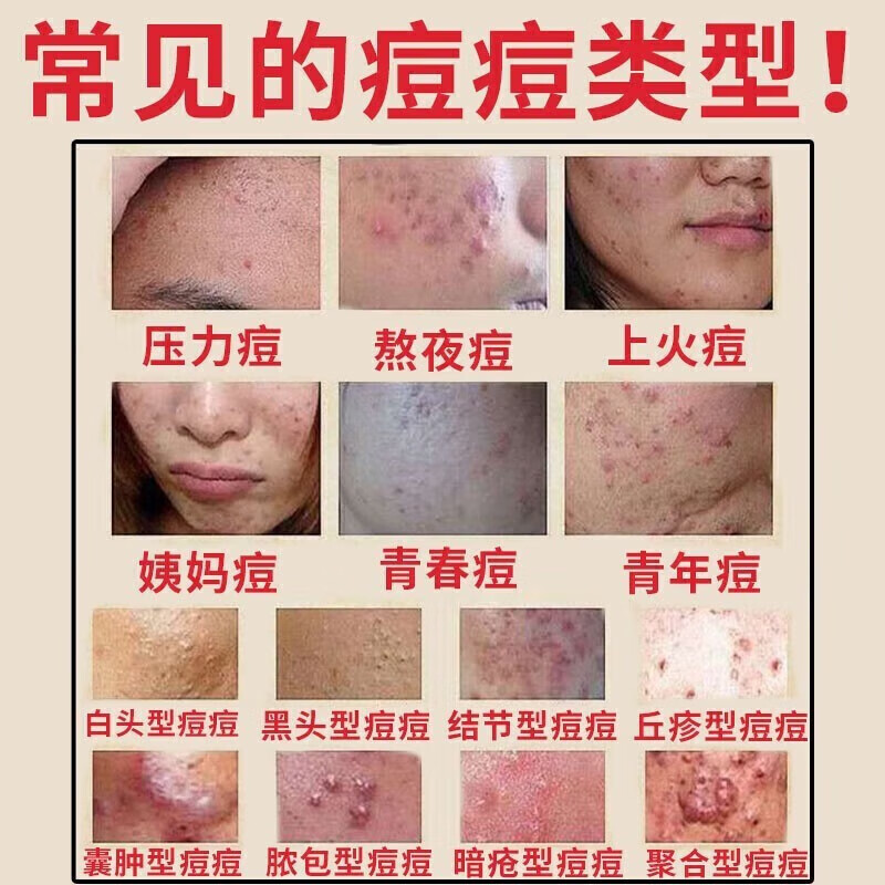 脸上长痘痘专用otc药青春期祛痘印修复淡化痘印痘坑修复药膏去痘痘和