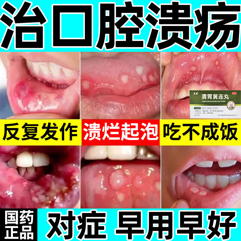 嘴里起泡口腔溃疡吃什么药特新效期药治舌头溃疡口腔专用嘴巴反复溃疡