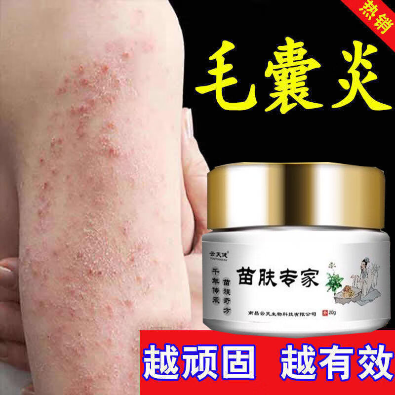 毛囊炎薬膏头部脸部背部胸部毛囊炎痘痘脓包痤l疮头皮l癣红点疙瘩湿