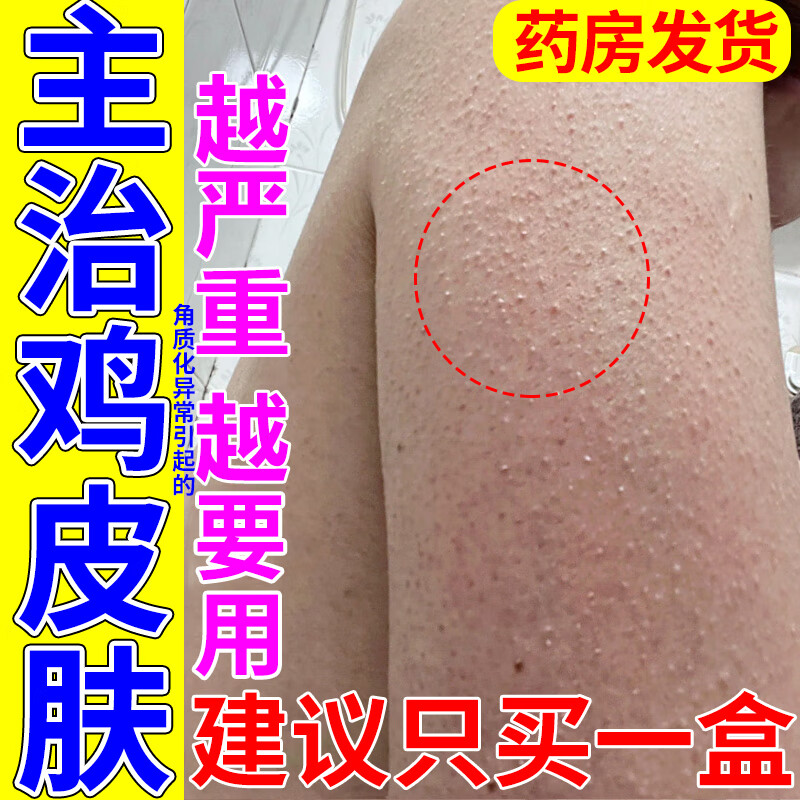 毛囊炎鱼鳞皮除胳膊大腿手臂背部毛周角化症皮肤角质化异常 1支基础装