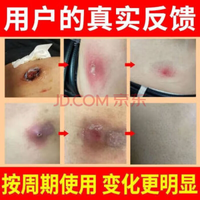 水之善火疖子拔l毒痒拔脓红肿拔l毒疙瘩大脓包痘痘坐扳疮屁股大包去脓 买3+2【五盒巩固装】