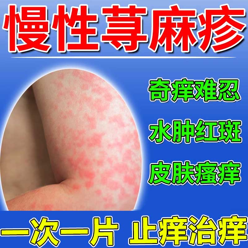 治荨麻疹药 荨麻疹过敏止痒皮肤过敏红疹止痒药皮肤瘙痒身上瘙痒长