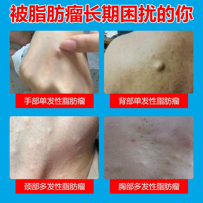 一瓶消瘤【98%消瘤只需两天】皮下多发性脂肪瘤硬肿块