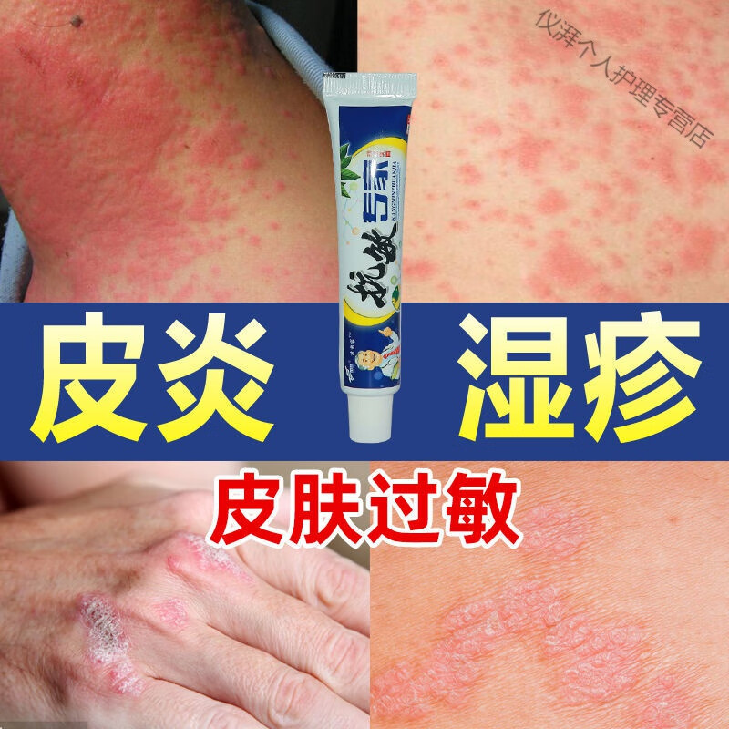 脸部瘙痒脱皮泛红起痘紫外线过敏性皮肤止痒膏专家 中度症状(买3 2)