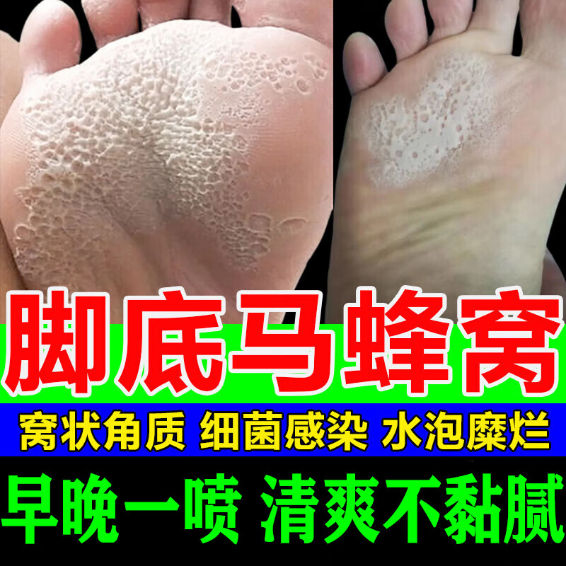 脚出汗专用药脚臭 止汗 真菌喷雾脚底蜂窝状脚气专用药窝状角质松解症