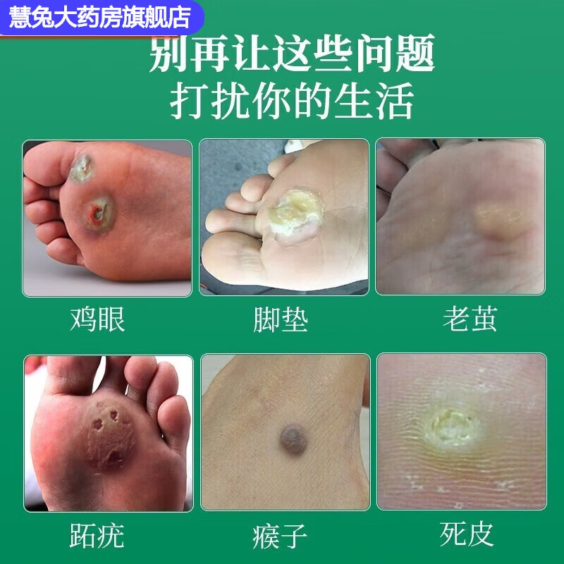 臧红花喷剂加赠鸡眼贴膏手部足部疣跖脚后跟脚垫老 喷剂/1盒 赠鸡眼贴