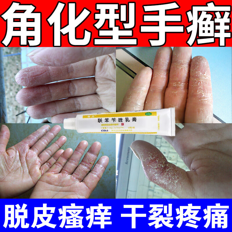 角化型手癣专用药】 顽固性手癣手指关节癣手掌粗糙增厚手指脱皮干裂