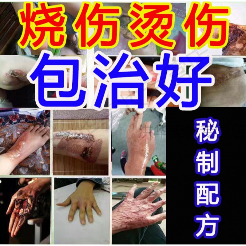 烧烫i伤膏外用儿童宝宝开水热油火烧伤水泡湿润生肌油