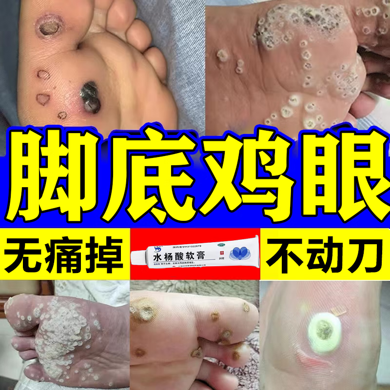 去黑头闭口粉刺10%-20去鸡眼去角质去老茧面部专用医用水杨酸上软乳膏
