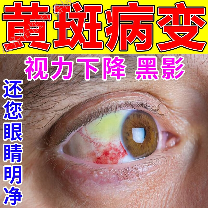 新品黄斑病变眼药眼白发黄出血眼底黄斑肿看不清眼球清澈 单盒装建议