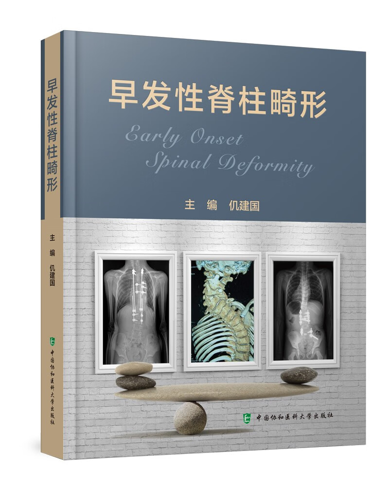 早发性脊柱畸形