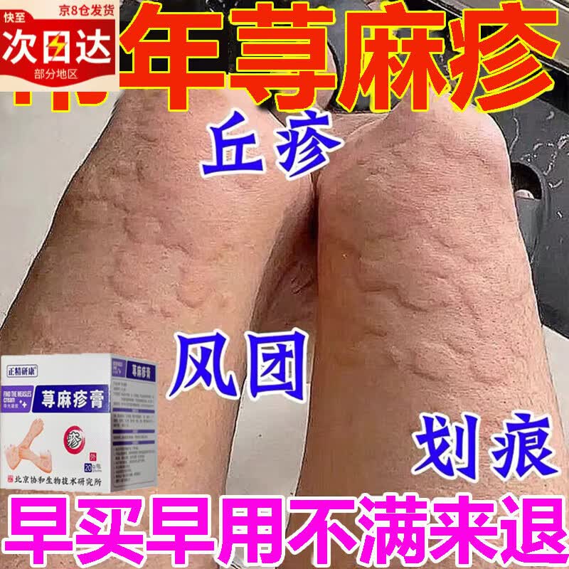 退热凝胶荨麻丘疹过敏止瘙痒断皮肤根瘙痒红疹起红疙瘩皮炎湿疹风 单