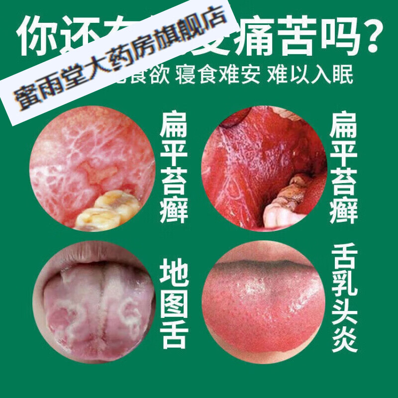 族人口腔扁平苔藓舌焱舌头 【1瓶装】体验装