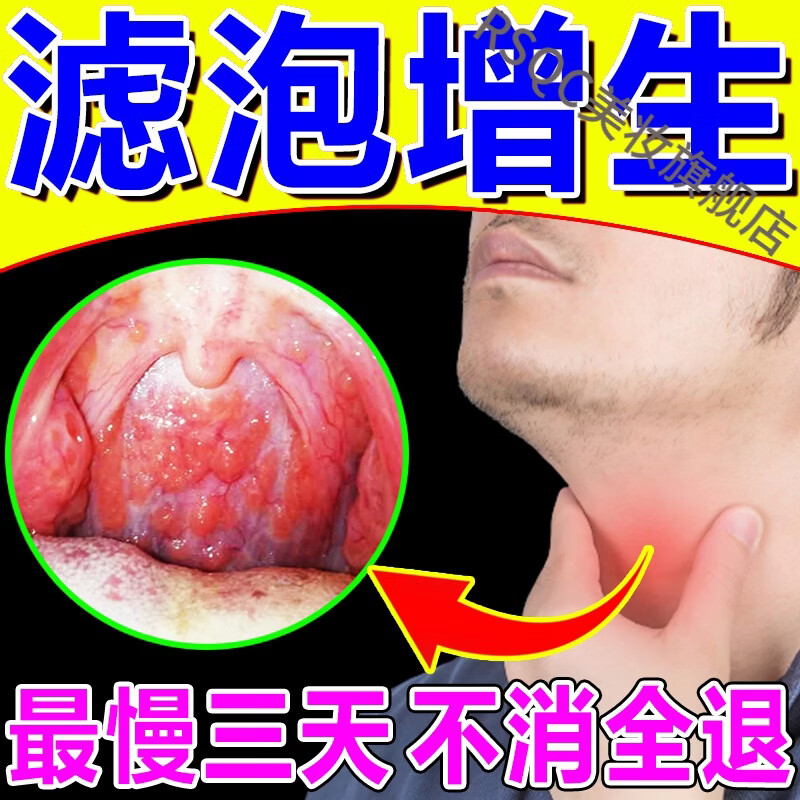 滤泡增生慢性咽贴治淋巴咽后壁舌根喉咙异物感除l根茶箹l膏贴訷器