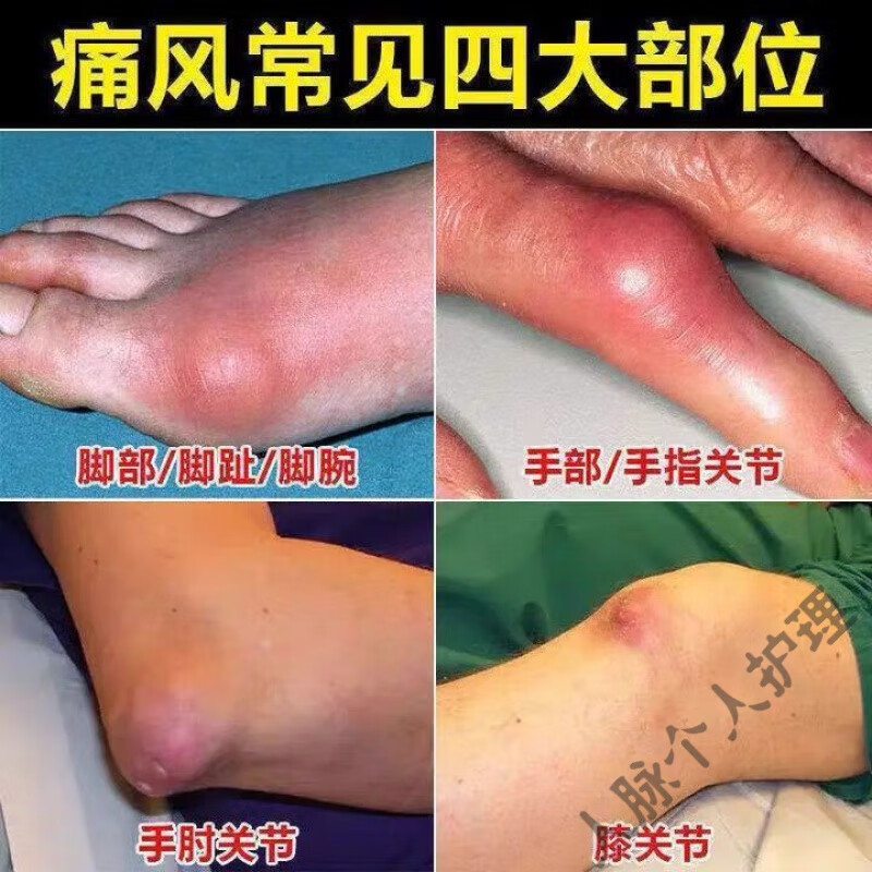 肿胀关节膝盖疼痛特傚消痛风石去l结晶冶大脚趾红肿鼓包手指关节疼痛