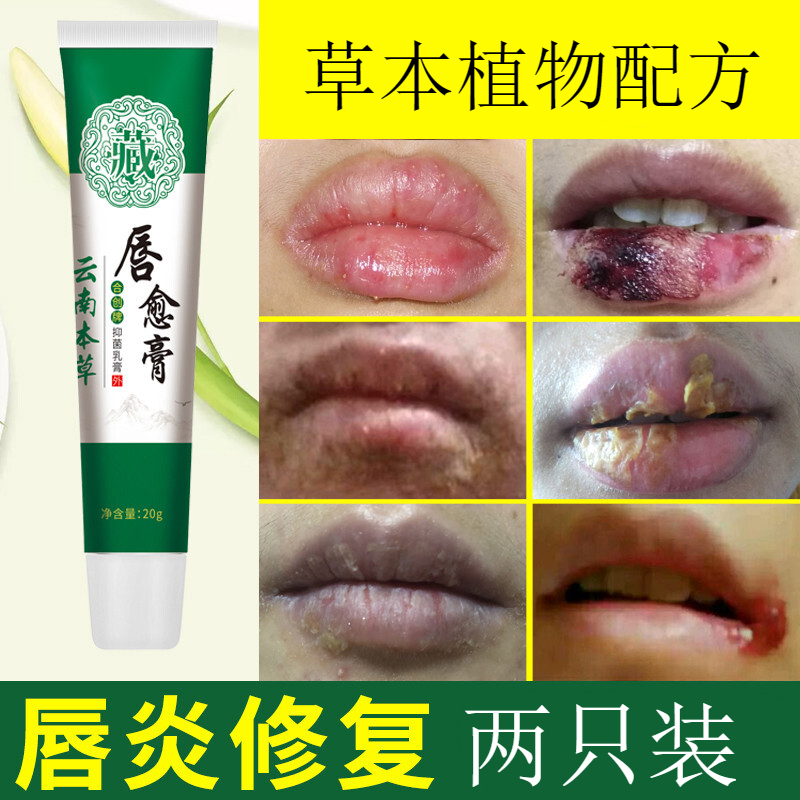 嘴唇干裂脱皮云南本草唇炎唇膏专用药修复嘴唇防干裂