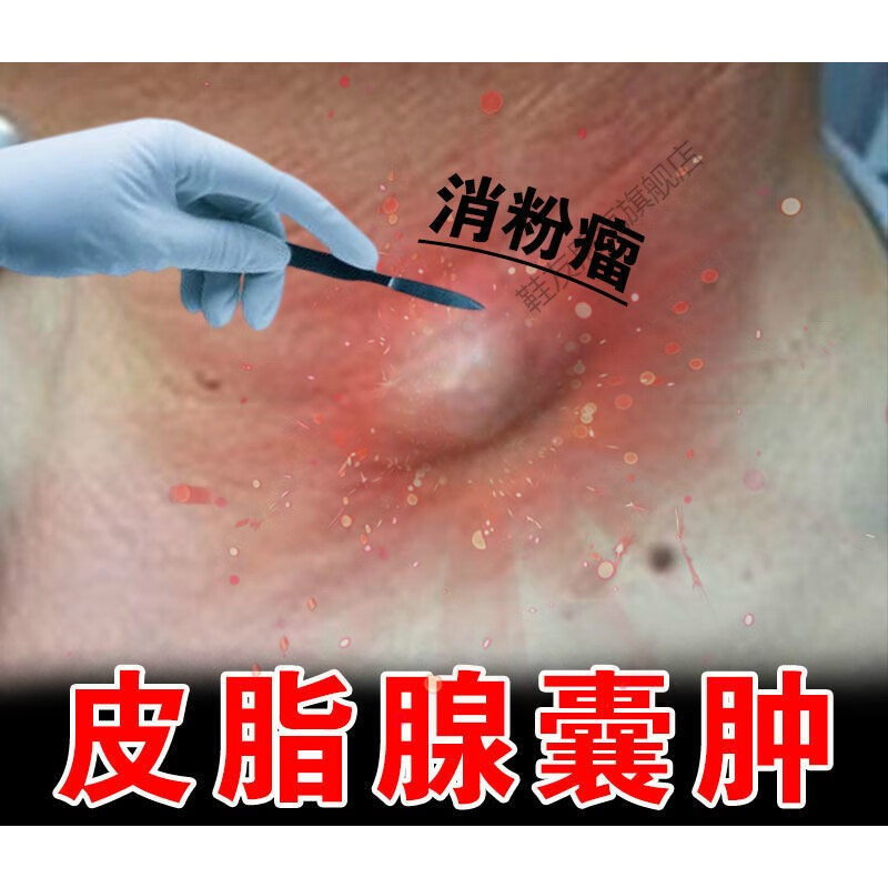 粉瘤专用膏消除皮脂腺囊肿皮下型硬块脓包红肿疼痛去除粉瘤膏 一盒