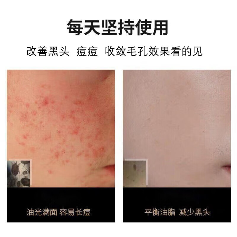 九叶草 氨基酸洗面奶男女男士洗面奶除螨控油去黑头去角质收缩毛孔倩滋 1瓶装【脸上瘙痒出油长痘螨虫在作怪】 脸上瘙痒出油长痘螨虫在作怪