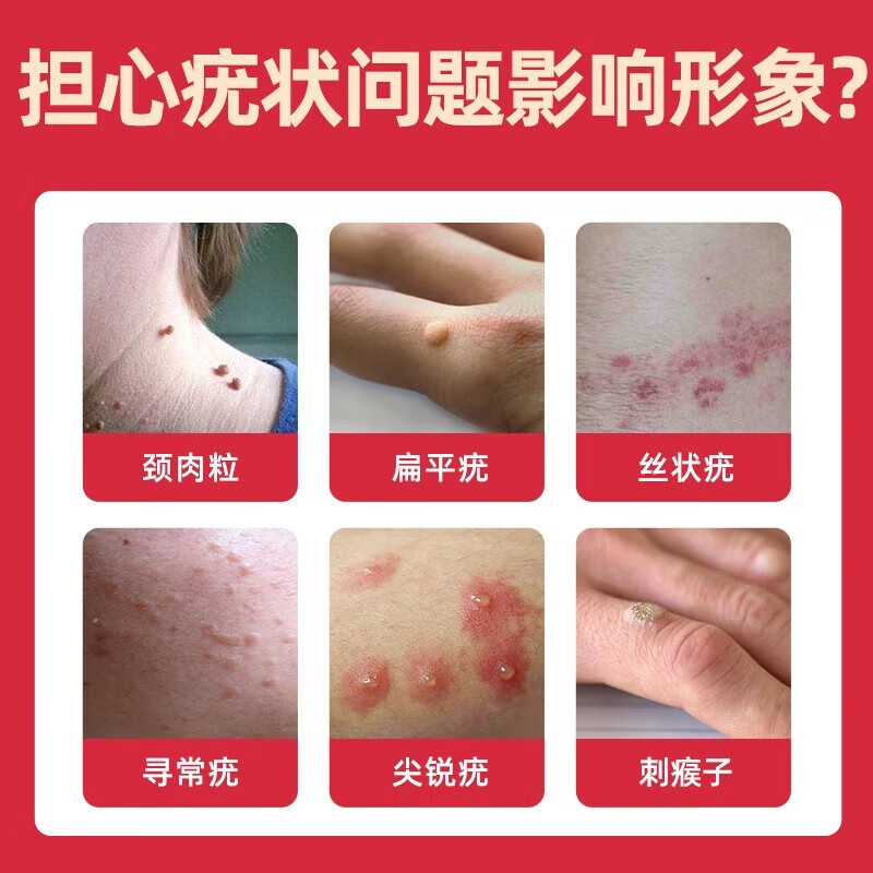 扁平疣专用膏的药1扁平疣面部去猴子祛扁平疣脖子 买二送一(到手三盒)