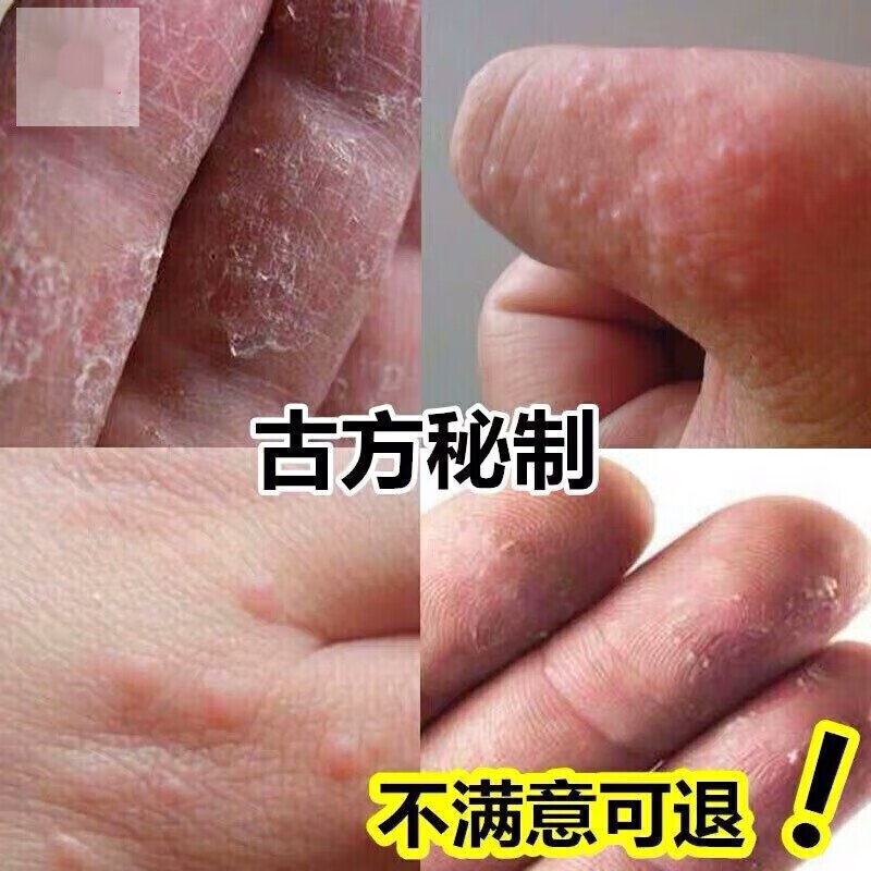 型邦手上起小水泡手氧手脱皮干裂真箘感染汗状疱诊孢诊乳膏 乳膏