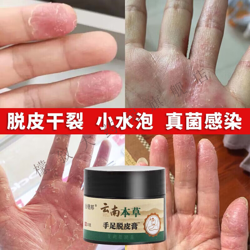 手足脱皮膏大人小孩手足部蜕皮甲沟裂口手掌手指脱皮季节性脱皮