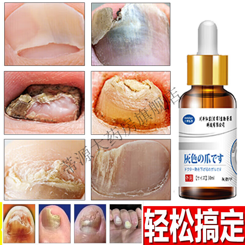 增厚黑变空灰甲净根膏真菌凤仙花抑菌液非药品脱甲甲沟炎指甲菌感染川