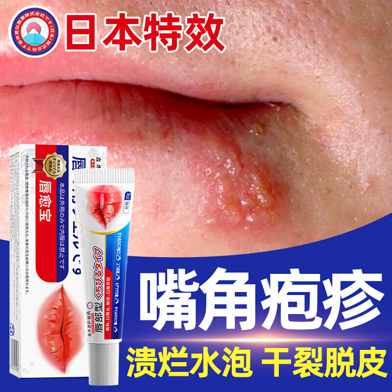 嘴角疱疹唇炎唇膏嘴唇干裂脱皮溃疡嘴角疱疹开裂口角炎烂嘴角药膏儿童