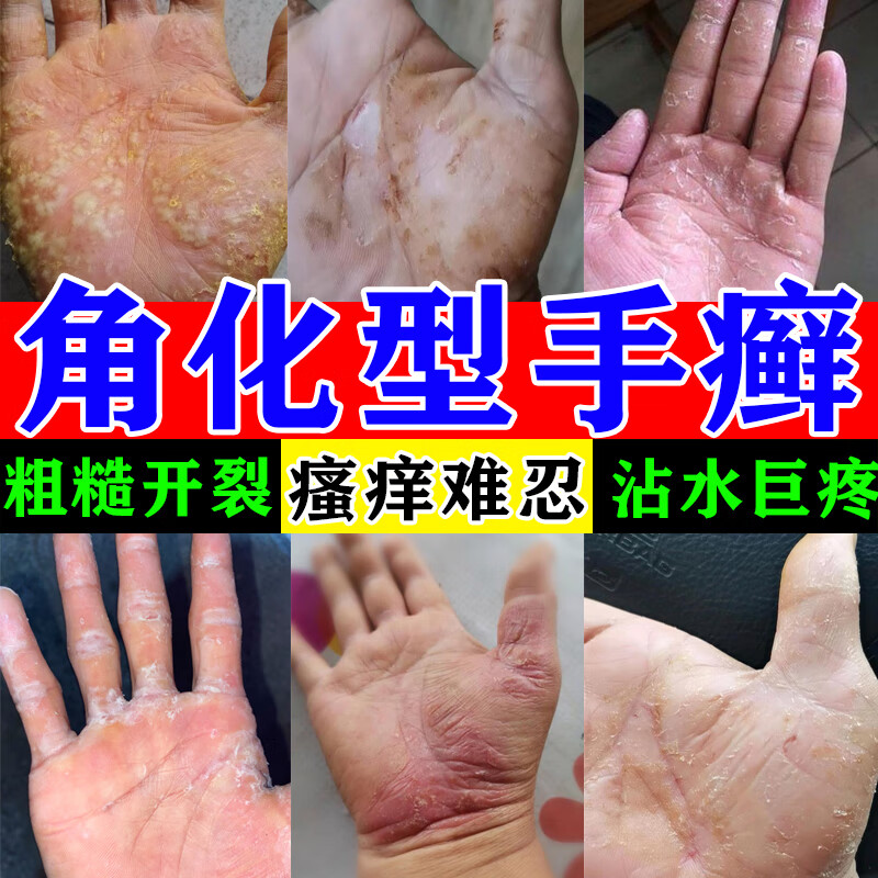 手指手掌脱皮干燥增厚粗糙角化鹅掌风顽固性手癣皮炎真菌感染皲裂性