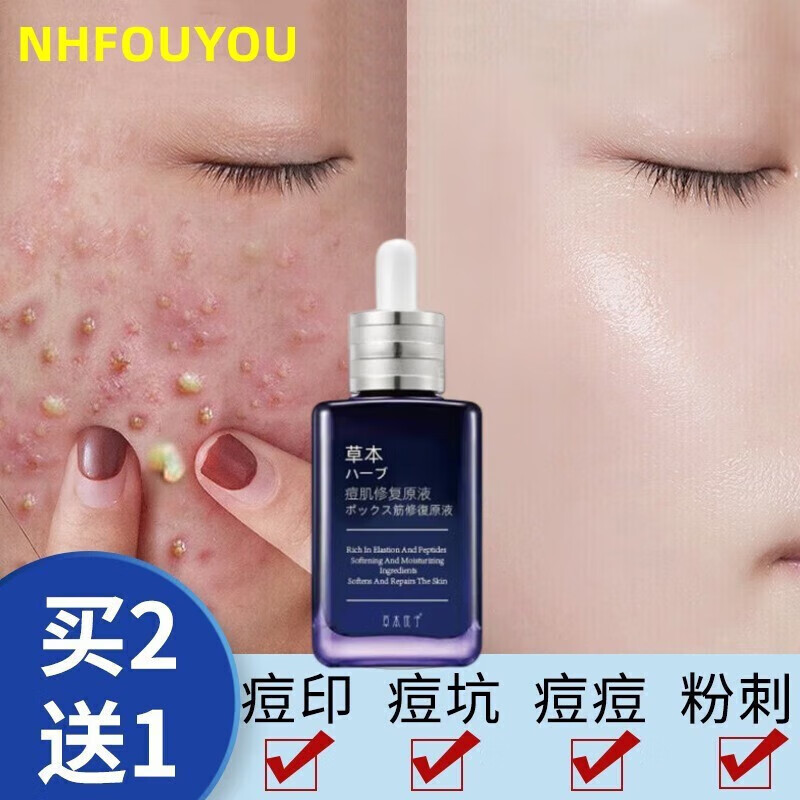 NHFOUYOU祛痘精华液祛痘膏去闭口粉刺痘坑痘印淡化消印收缩毛孔精华液 一瓶【30ml】建议按疗程使用
