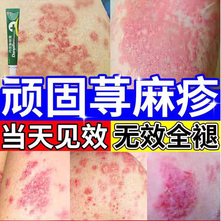 荨麻疹特l效药反复丘疹性荨麻疹专科專用药慢性荨麻疹皮肤瘙痒止痒特l