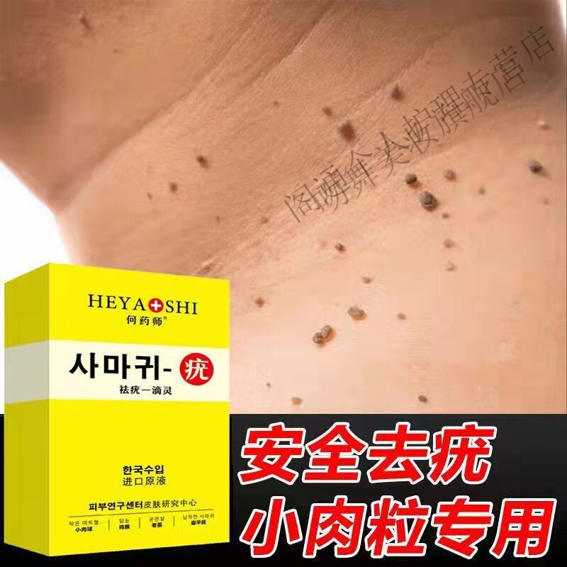 去除脖子小肉粒小猴子颈部赘皮扁平尤丝状1疣腋下疣专用液 轻度三年