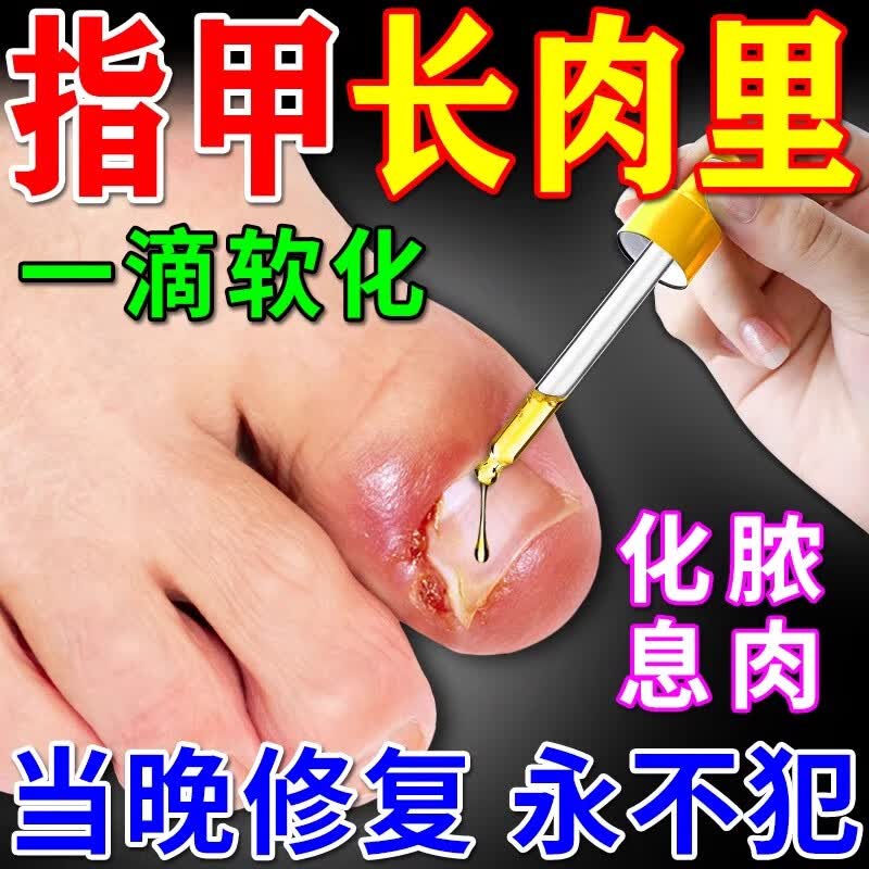 甲沟炎专的用根甲沟炎特傚效i药治消肿去肉芽指甲往肉里长矫正器 一盒