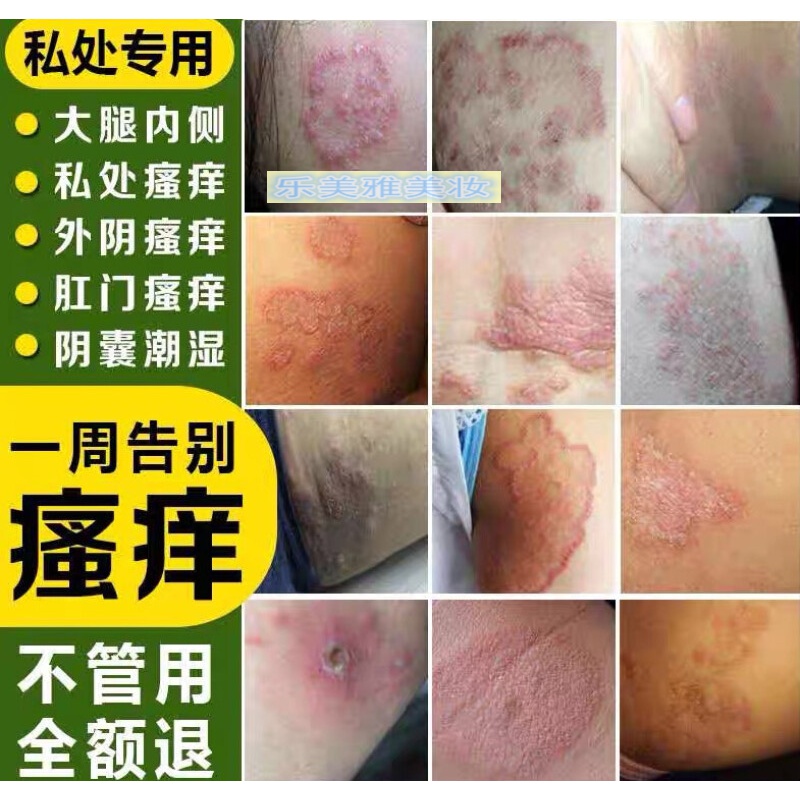 屁眼痒私处肛门濕的疹肛周瘙痒止痒膏成人男士阴囊女性外阴潮湿痒霜
