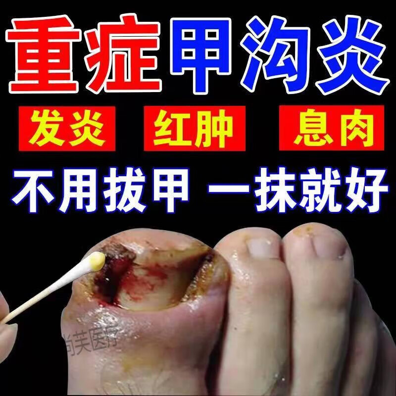 甲沟炎消肿神器嵌甲甲沟红肿疼痛器软化脱甲治疗膏 单盒装