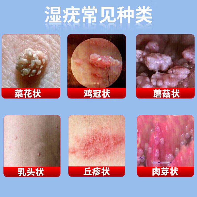 尖锐湿疣可搭五氟脲嘧啶软膏氟尿软膏扁平疣丝状疣瘊猴子肉粒 1瓶