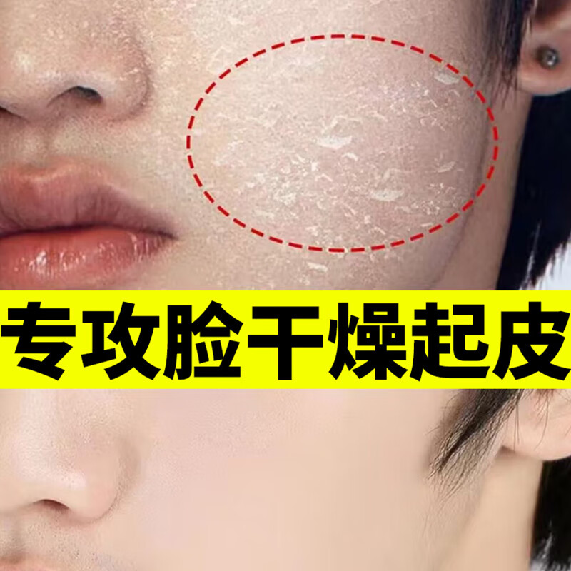 晨译禾脸上起皮干燥脸干男女士去角质幼儿过敏红痒脱皮冬季补水男女 1