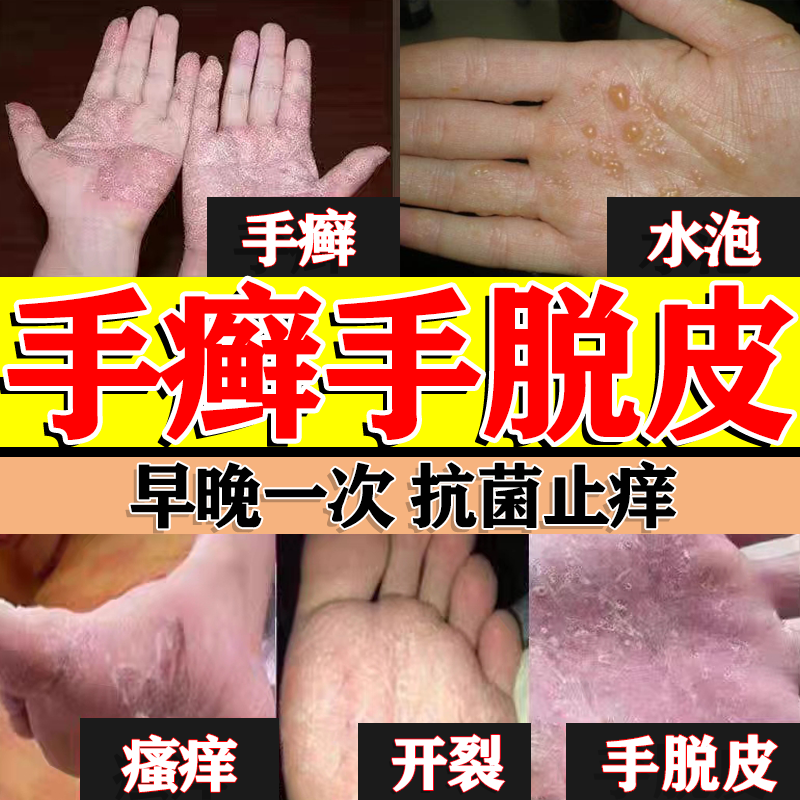 手脱皮用什么药 手癣真菌感染药膏脱皮手开裂干裂脱皮 真菌感染皮肤