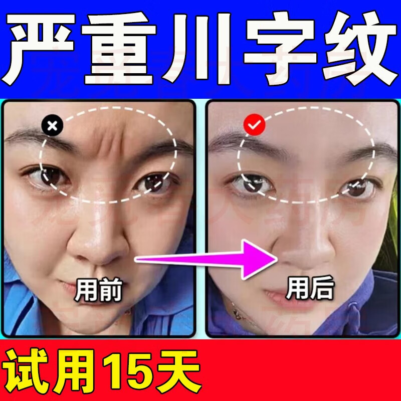 【官方大药房直售旗舰】川字纹去除神器按摩抗i皱抬头纹悬针纹修复