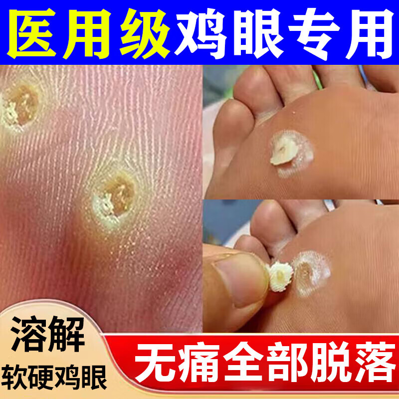 2g*6贴/盒鸡眼膏去根肉刺药膏无痛脱落鸡眼专用溶解角质层皮肤用药ty
